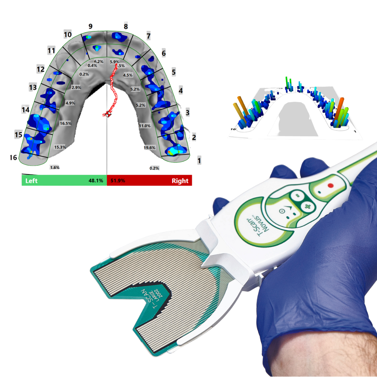 Analyse numérique des forces et de la chronologie des contacts d'occlusion dentaire avec le système T-Scan Novus - Distribution Mescan